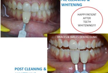 How much does teeth whitening cost in Pune?