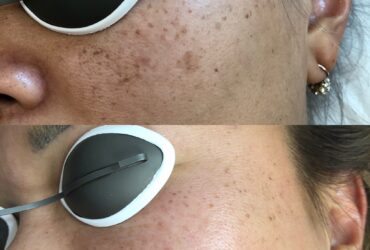 Say Goodbye to Age Spots with our Laser Treatment