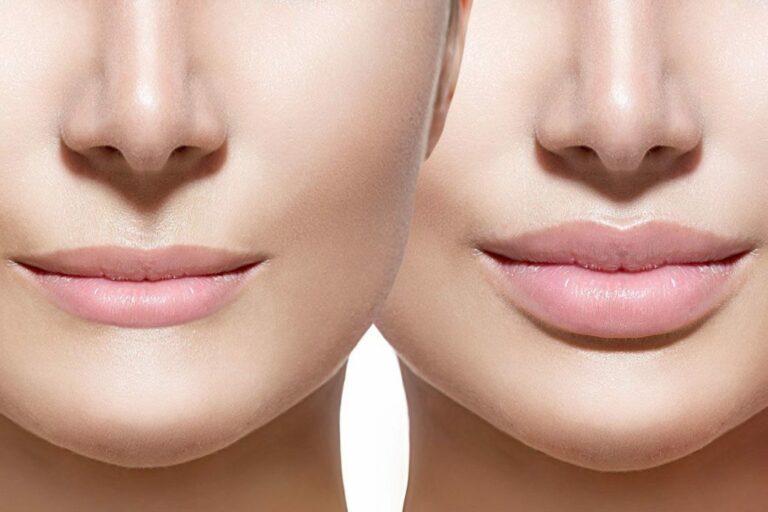 Lip Reduction Surgery Cost in Hyderabad